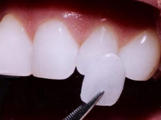 Faccette Dentali Cosa Sono