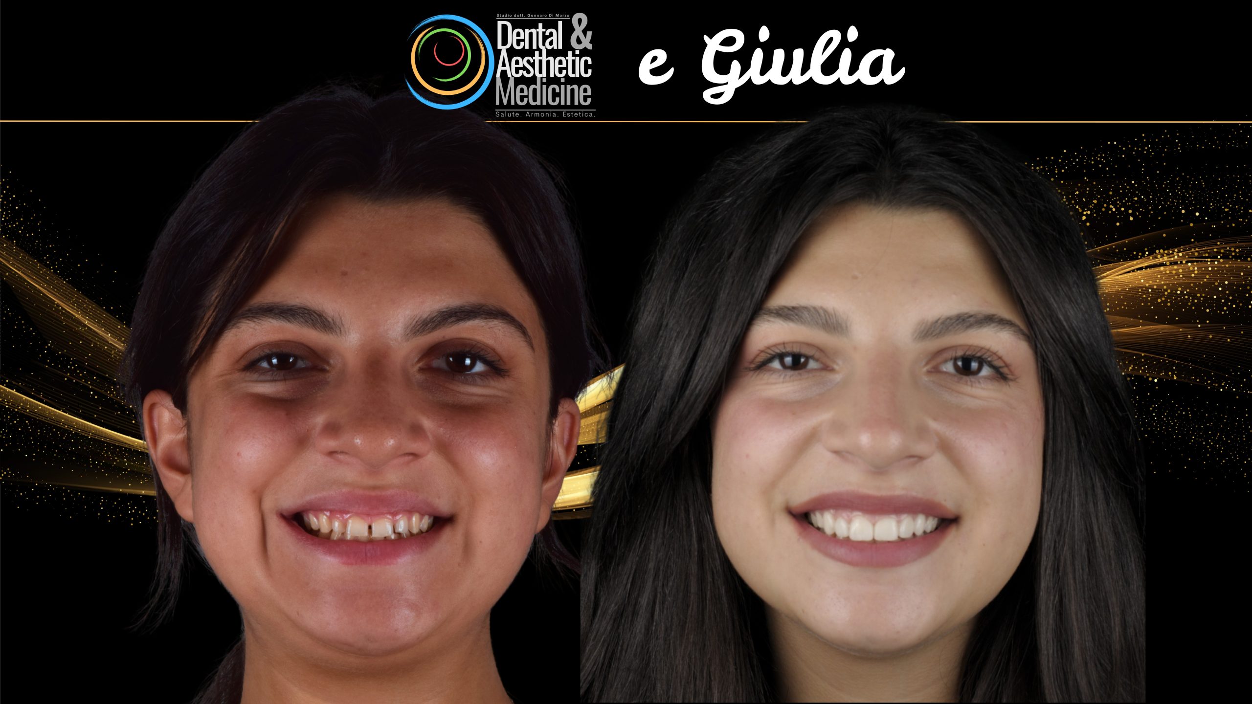 Faccette Dentista Faccette Sui Denti 11