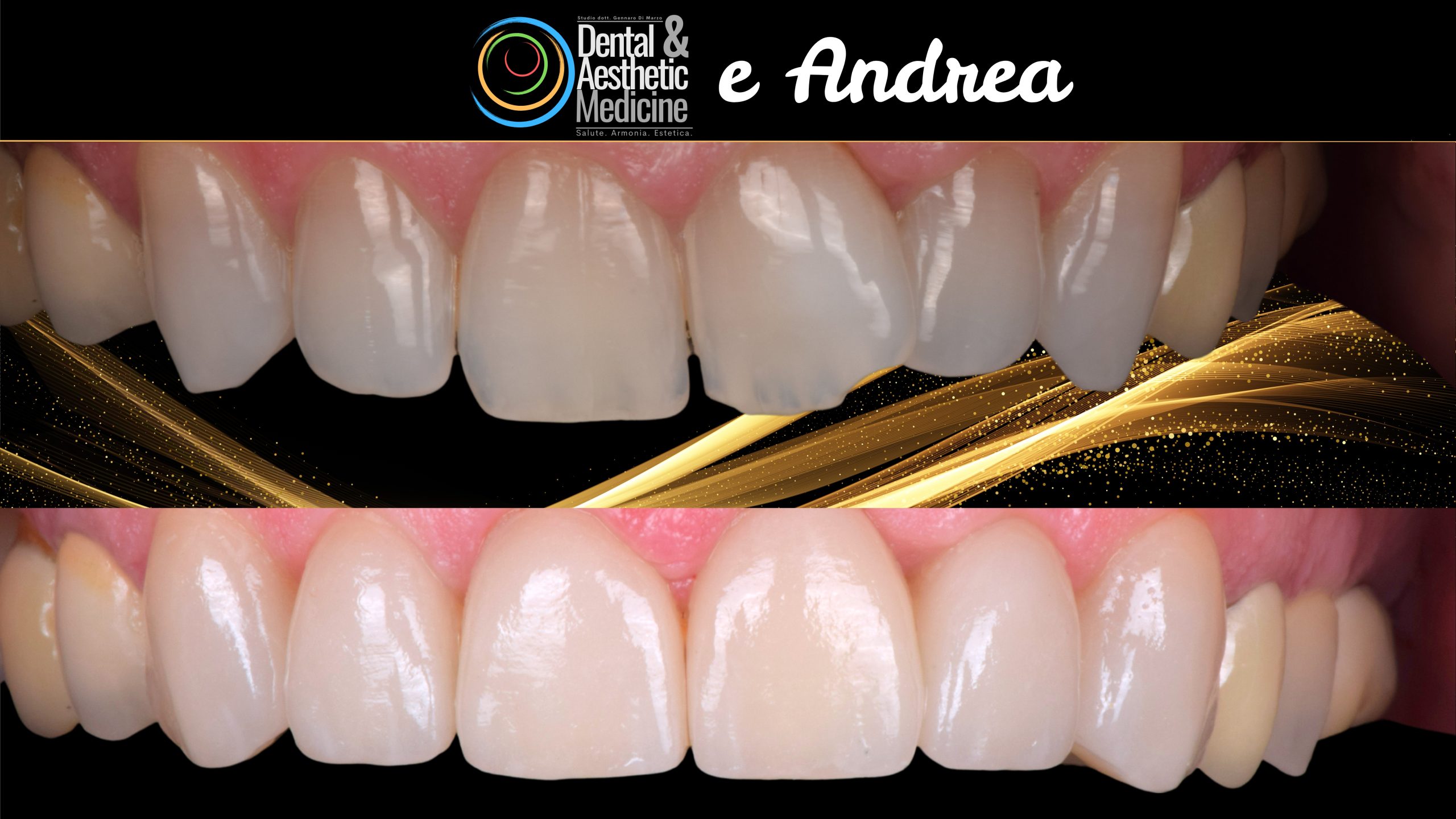 Faccette Dentista Faccette Sui Denti 3 Scaled