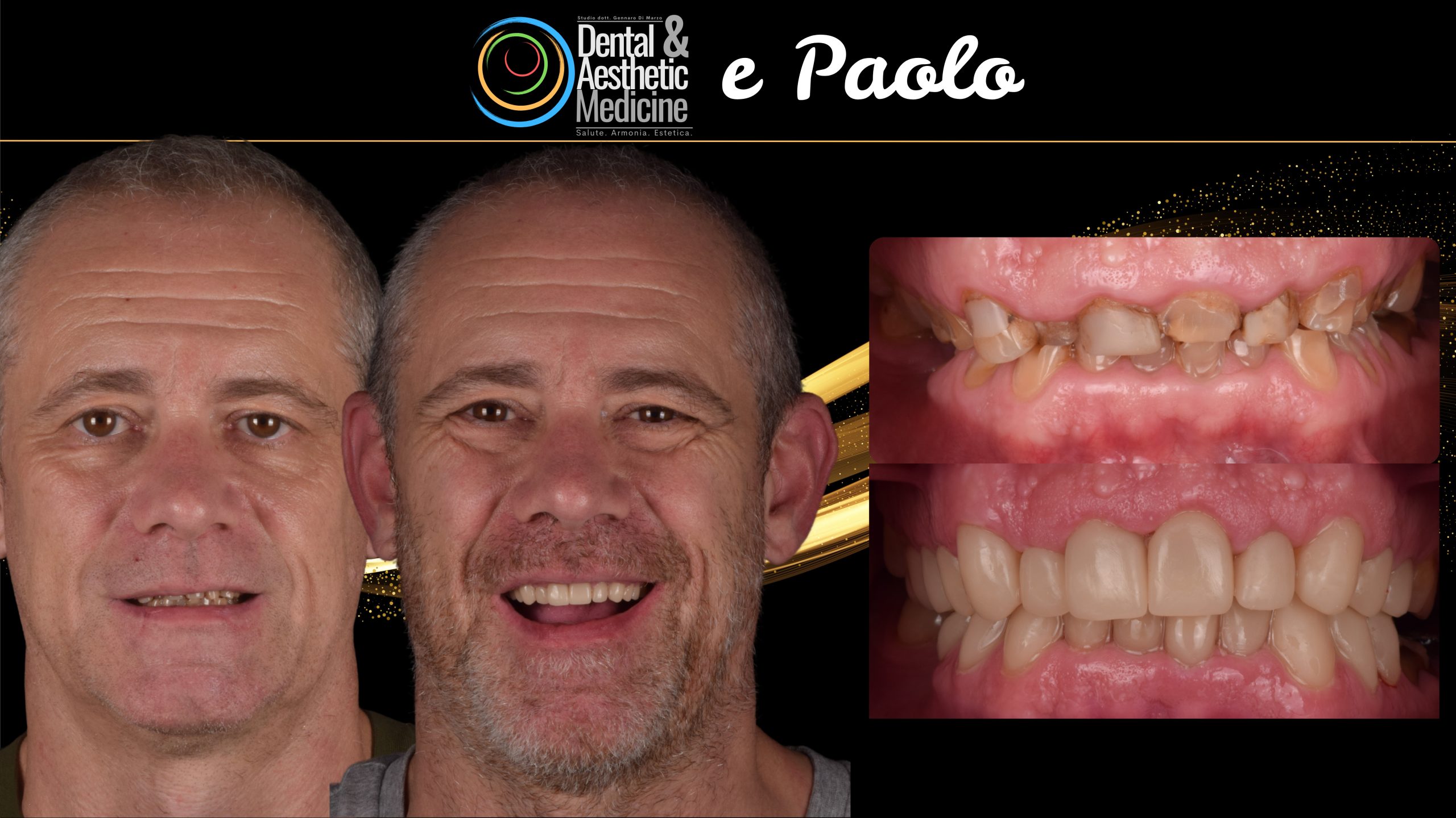 Faccette Dentista Faccette Sui Denti 4 Scaled