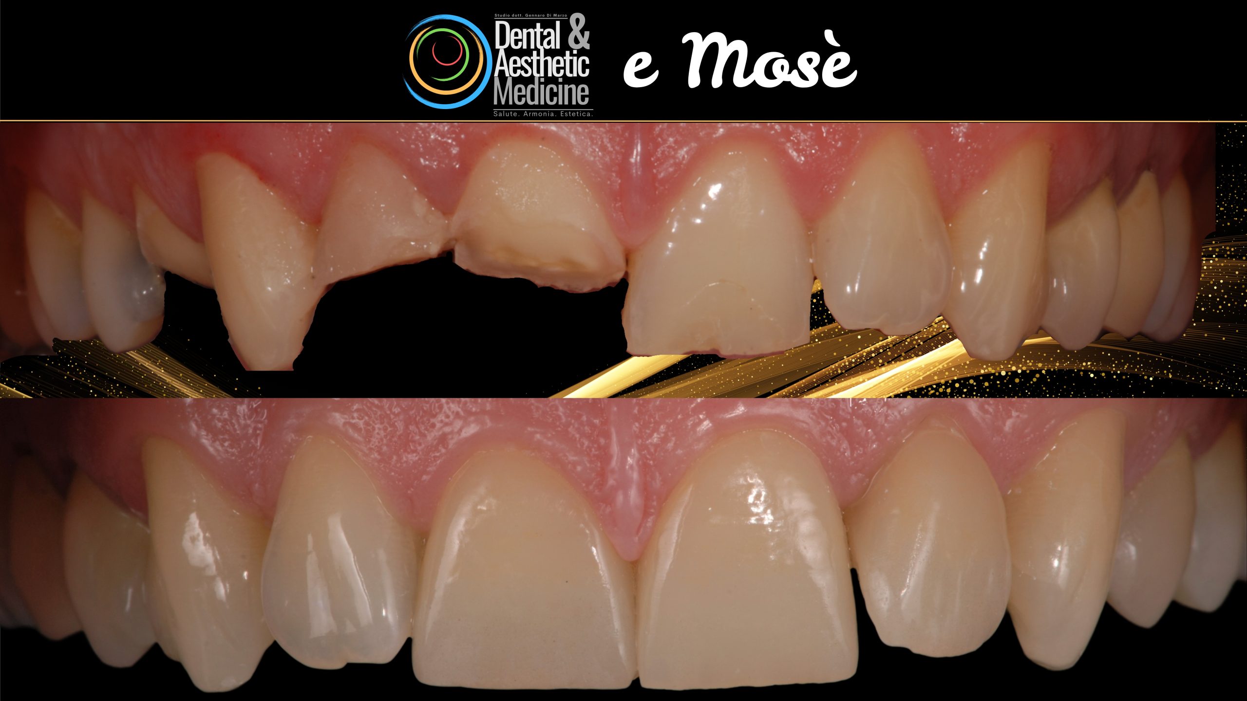 Faccette Dentista Faccette Sui Denti 5 Scaled