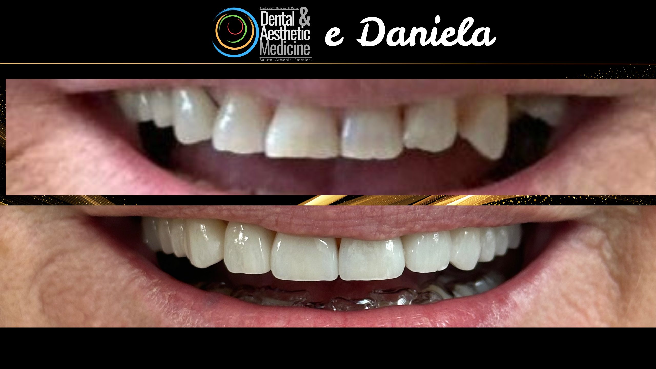 Faccette Dentista Faccette Sui Denti 7 Scaled