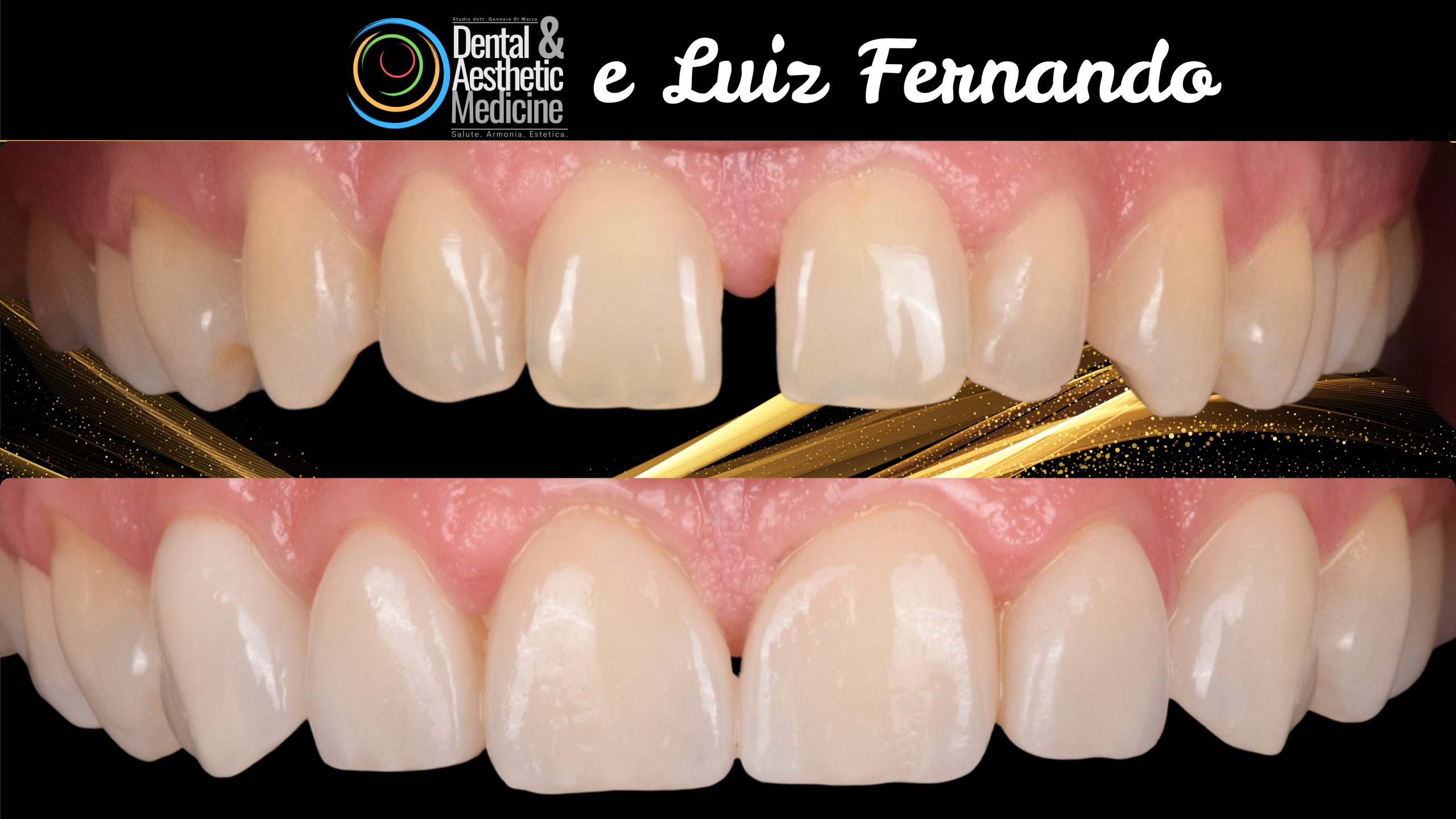 Faccette Dentista Faccette Sui Denti 8 Scaled