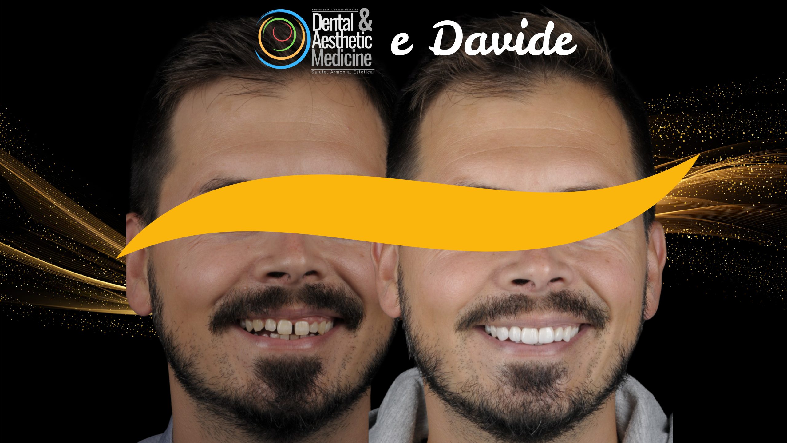 Faccette Dentista Faccette Sui Denti 9 Scaled