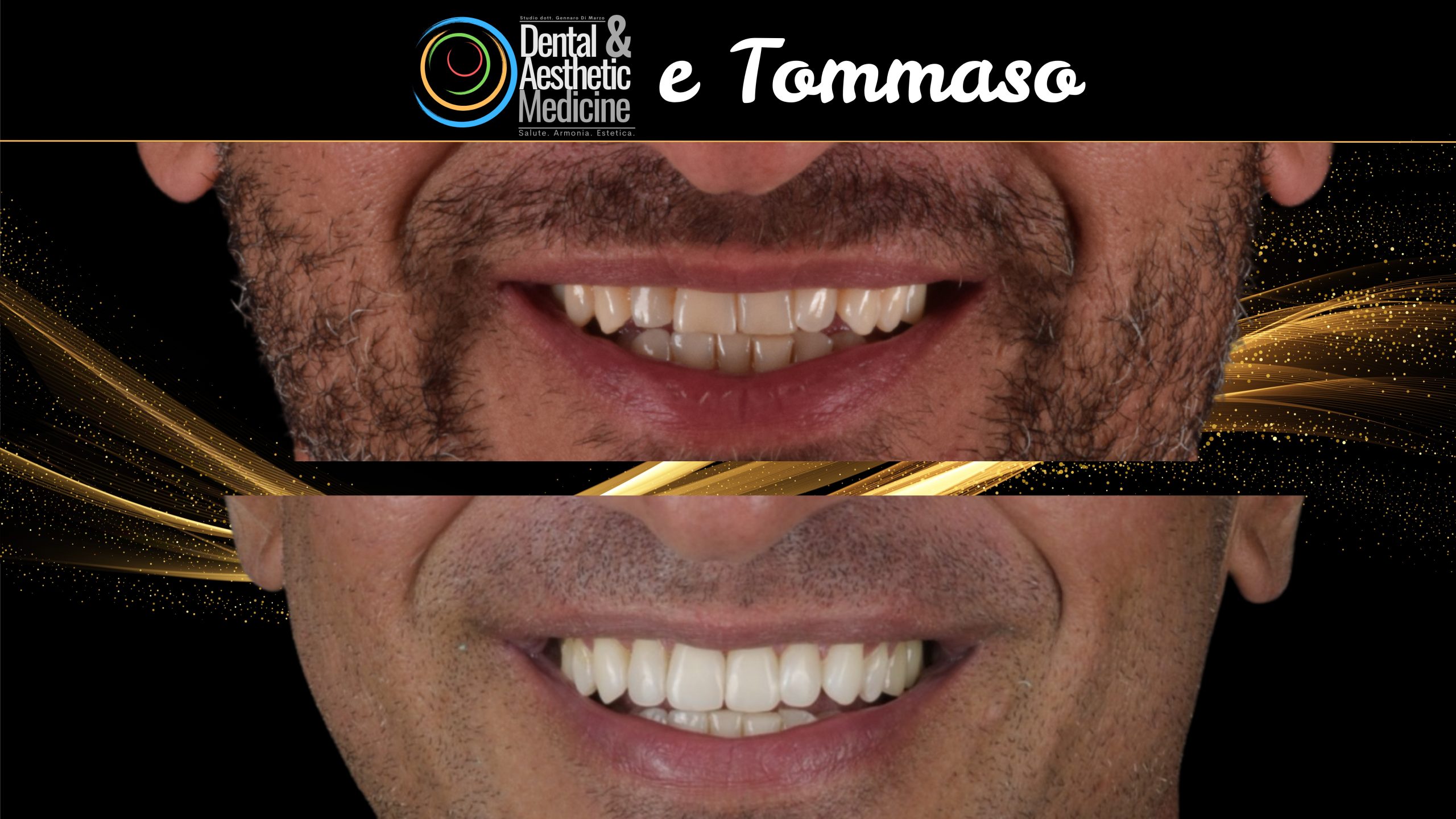 Faccette Dentista Faccette Sui Denti Caso Trattato Da Dentista Firenze Con Injection Techinique