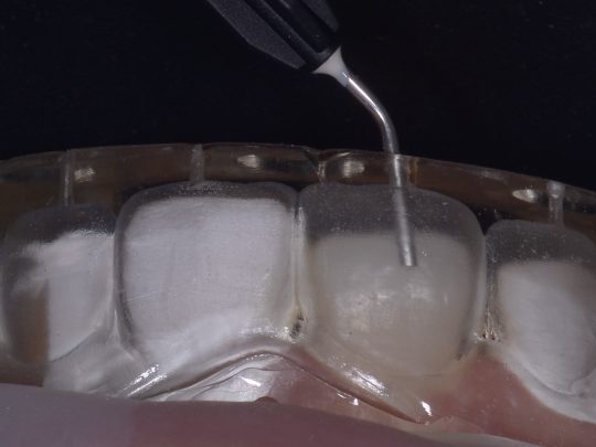 https://estetica-dentale.it/website_4247738d/wp-content/uploads/2026/04/faccette-per-denti-540x405.jpeg